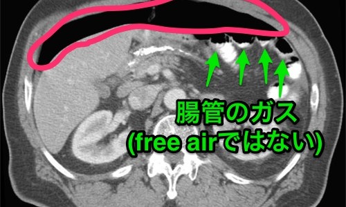 穿孔に造影剤は禁忌? 穿孔に造影剤は禁忌?