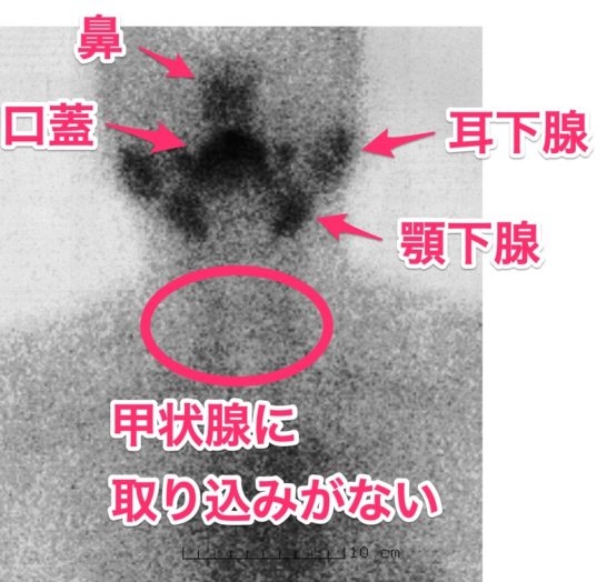 無痛性甲状腺炎のTcシンチ