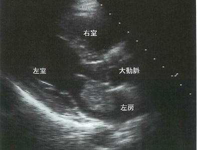 感染性心内膜炎と左房粘液腫の鑑別のポイント 感染性心内膜炎と左房粘液腫の鑑別のポイント