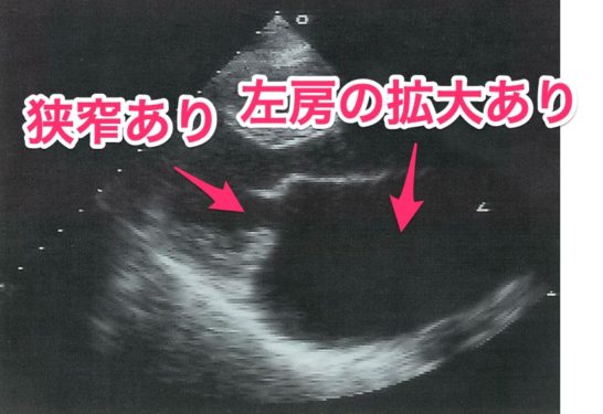 僧帽弁狭窄症の心エコーの所見
