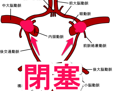 もやもや病と脳動脈奇形との見分け方 | 病歴を重視しよう もやもや病と脳動脈奇形との見分け方 | 病歴を重視しよう