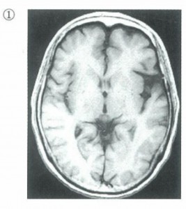 MRI-T1