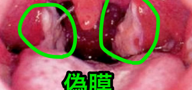 ジフテリアはなぜ2類感染症? ジフテリアはなぜ2類感染症?