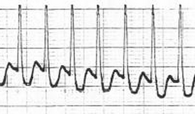 発作性上室頻拍の心電図