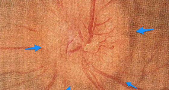 髄液検査の禁忌は? 髄液検査の禁忌は?