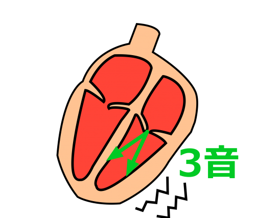 Ⅲ音が生じる機序