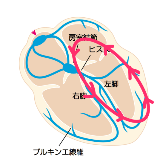 A型WPW症候群の病態