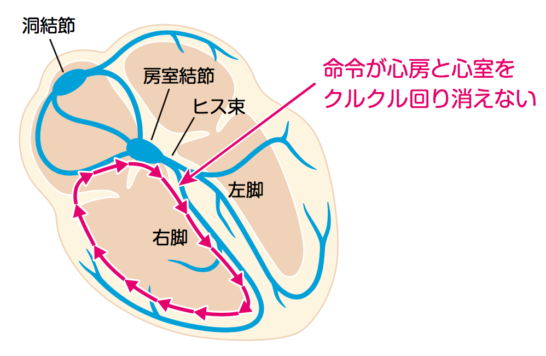 B型WPW症候群の病態