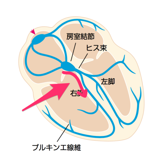 C型WPW症候群の病態