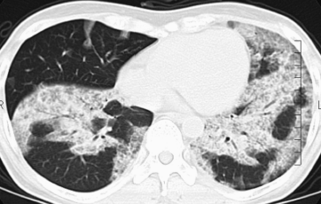 医師国家試験105I63_画像B_肺胞蛋白症の胸部CT写真