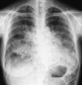 医師国家試験105I63_画像A_肺胞蛋白症の胸部レントゲン写真