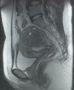 子宮腺筋症のMRI