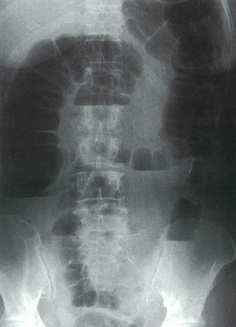 医師国家試験99H13_画像_腸閉塞（イレウス）の腹部X線