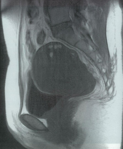 子宮腺筋症のMRI