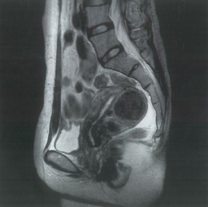 子宮筋腫のMRI