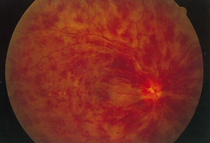 医師国家試験107D25_画像_網膜中心静脈閉塞症の眼底写真