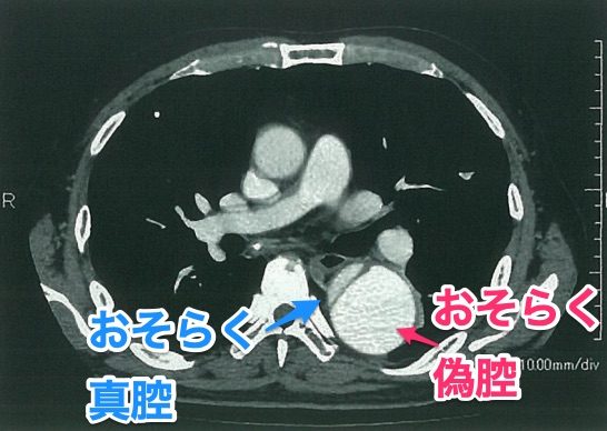 【104A23】大動脈解離のCT-編集