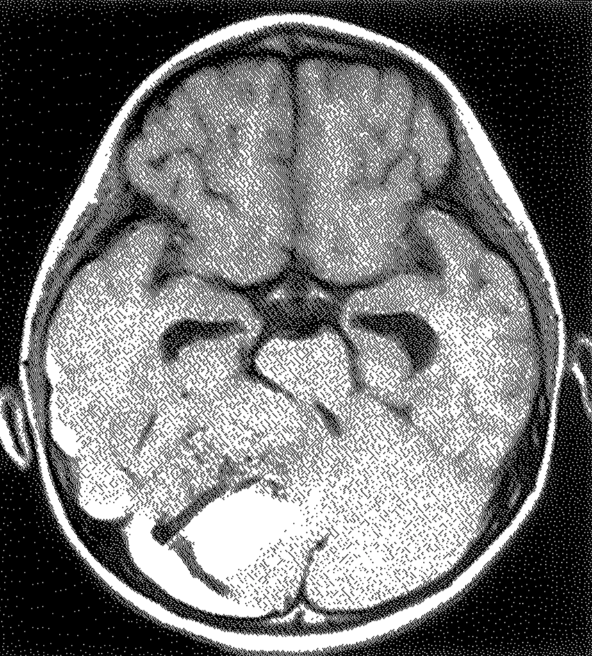 医師国家試験100A46_画像A_脳動静脈奇形の頭部MRI