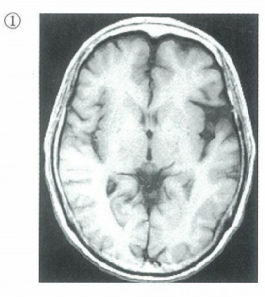 MRI-T1