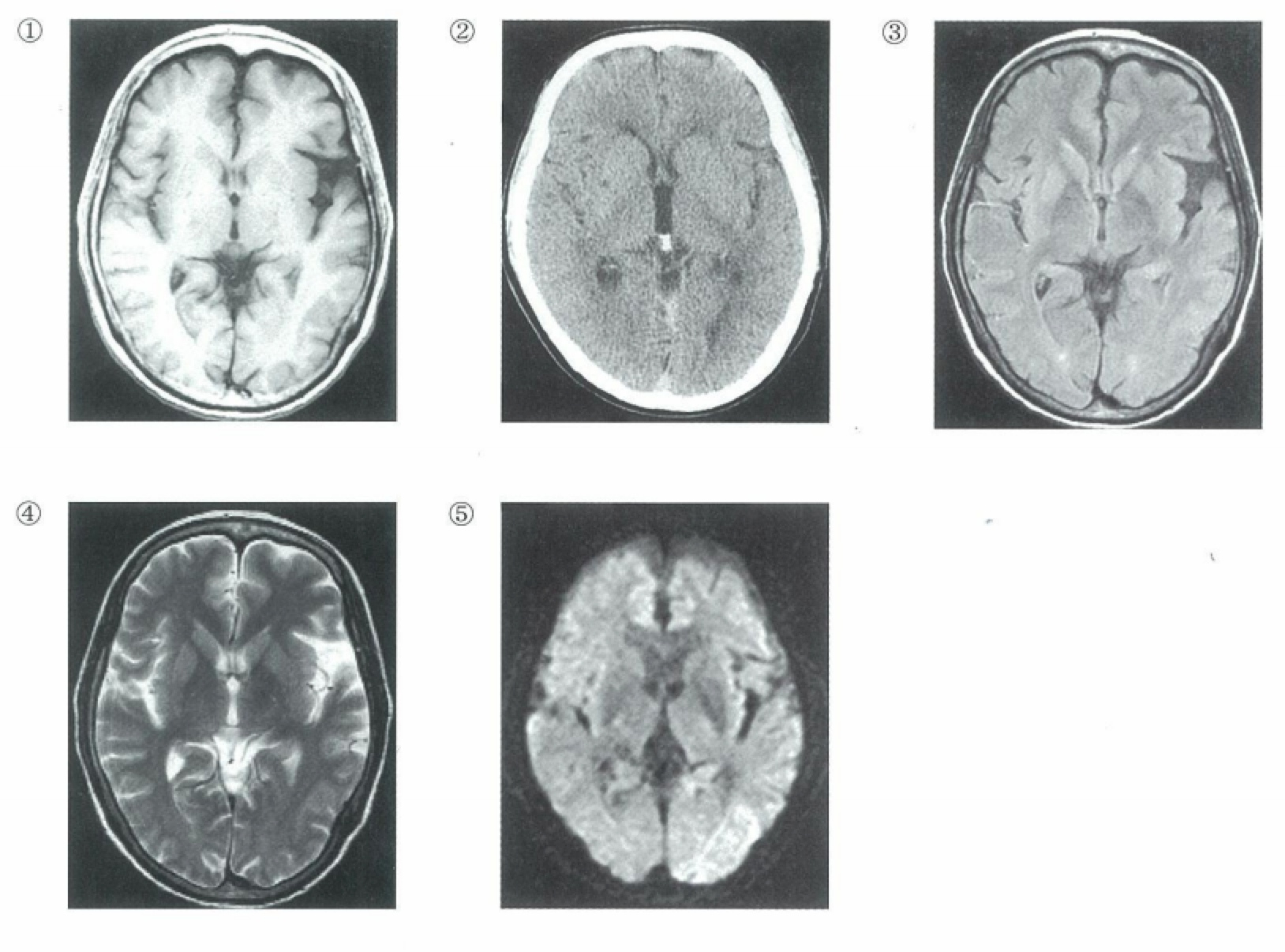 頭部MRI