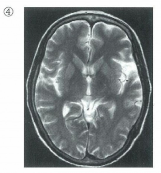 MRI-T2