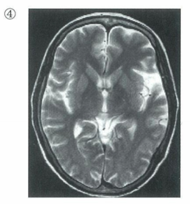 医師国家試験99D103_画像4_MRIのT2強調画像