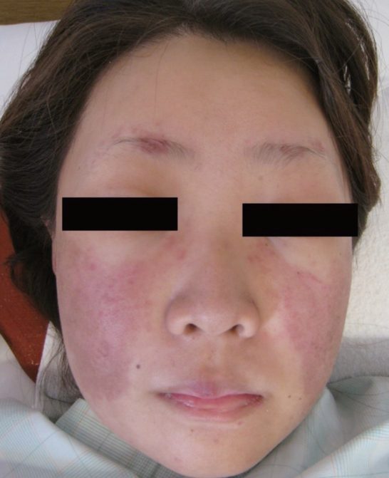 医師国家試験108B48_画像_SLEの顔面の写真（蝶形紅斑）
