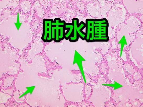 肺水腫