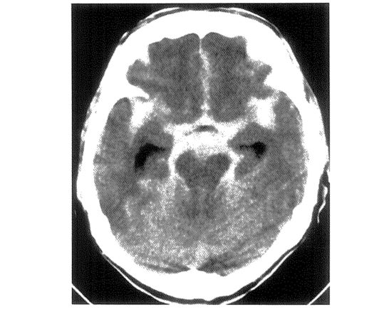クモ膜下出血のCT_【100H18】