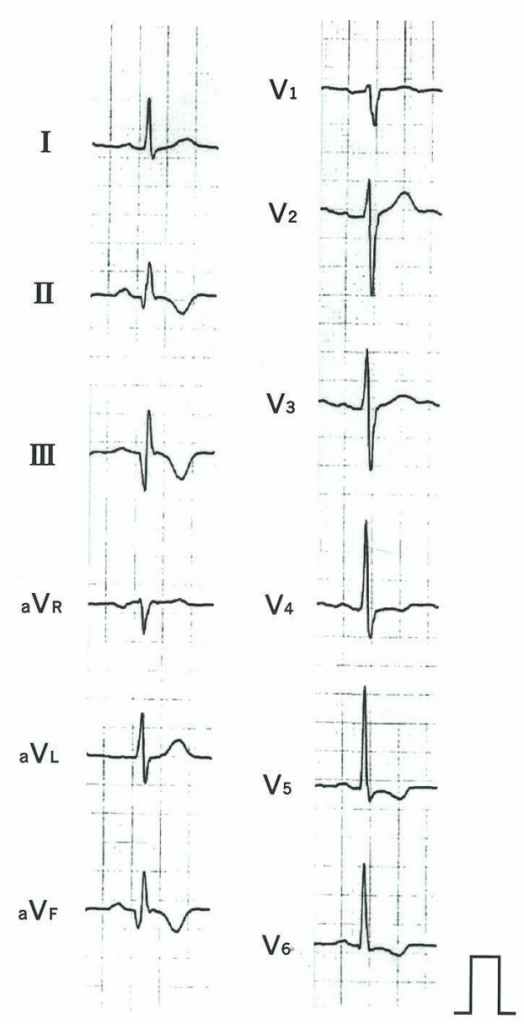 医師国家試験95D20_画像A_不安定狭心症の心電図