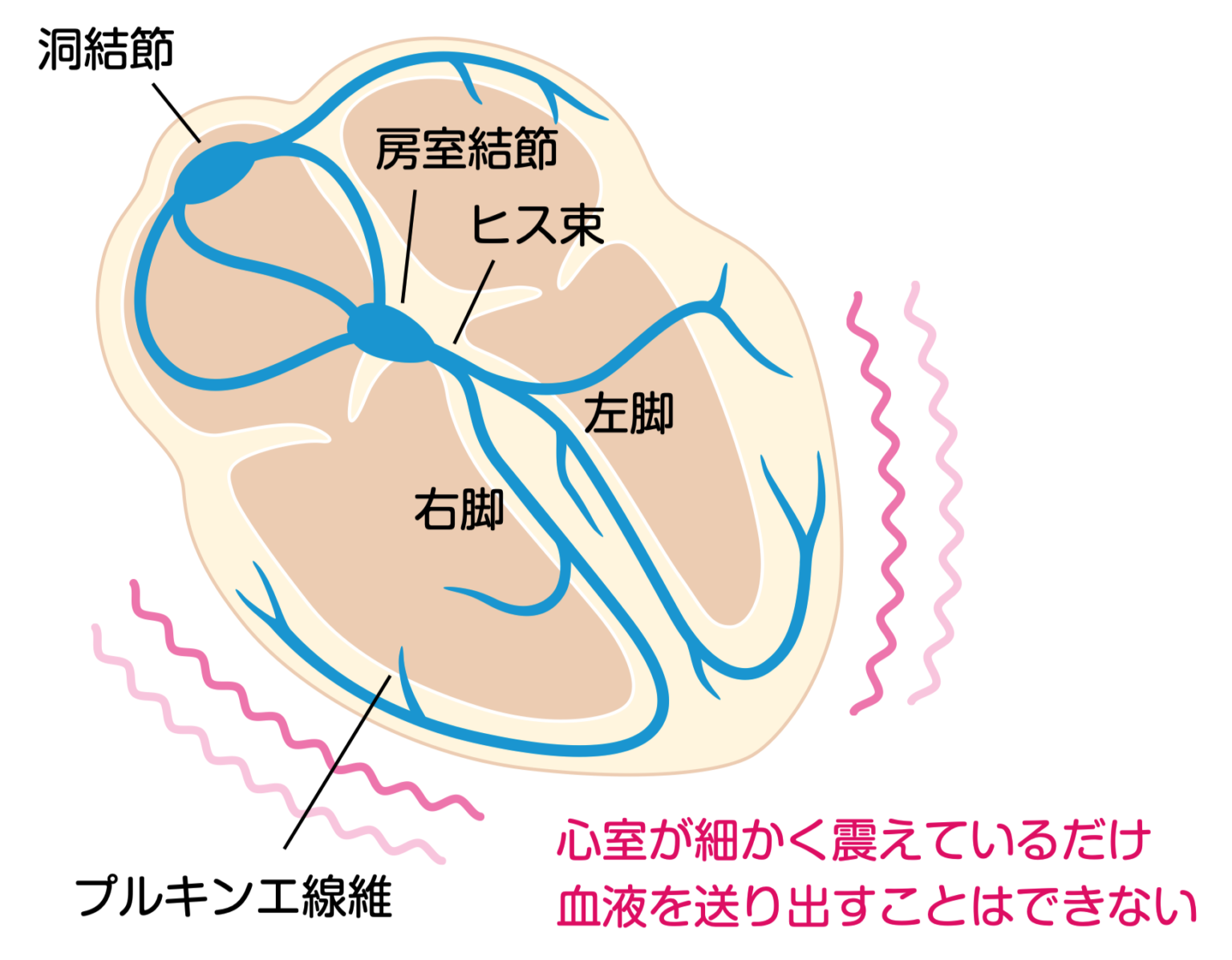 2-1 心室細動の心電図【ブログ版 これだけ心電図】 | コウメイ塾