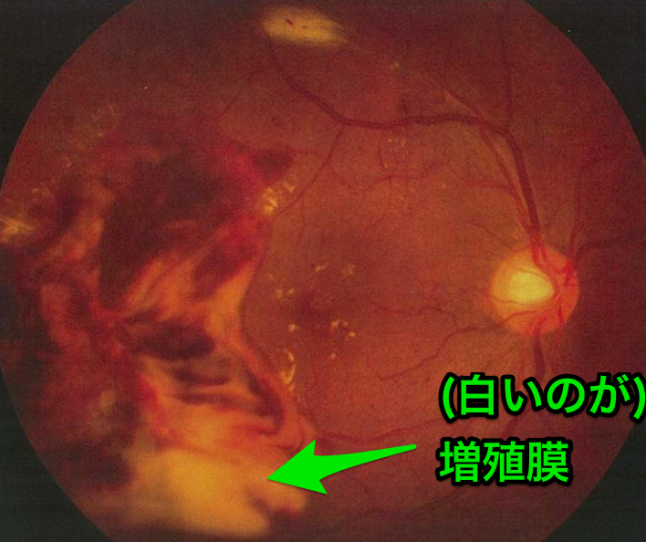 医師国家試験101A10_画像_改変_糖尿病網膜症の眼底写真（増殖膜）