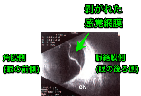 網膜剥離の超音波_エコー_