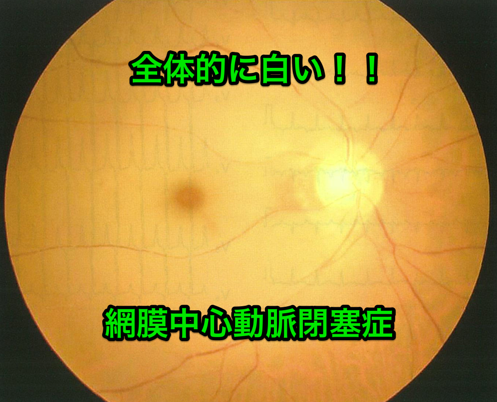 医師国家試験104G54_画像A_網膜中心動脈閉塞症の眼底写真_改変