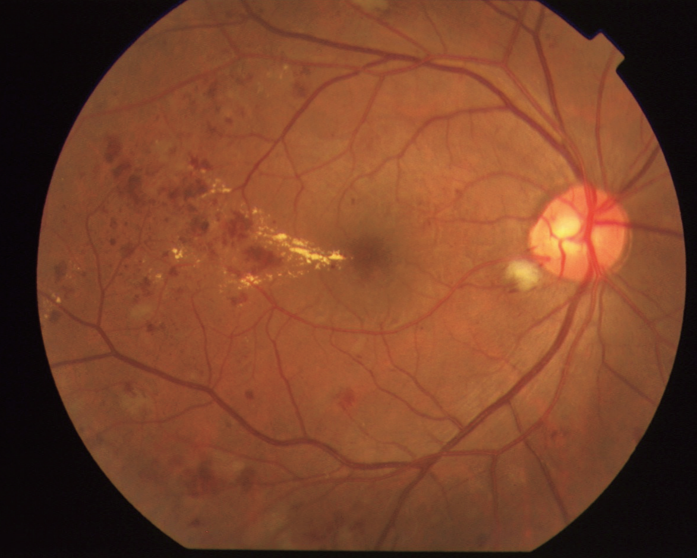 医師国家試験108C24画像A_糖尿病網膜症（軟性白斑）の眼底写真