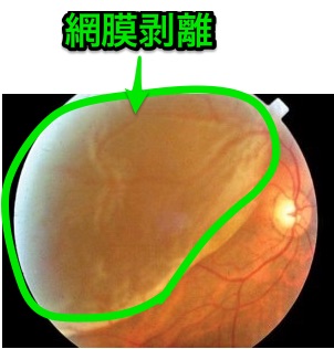 網膜剥離の眼底