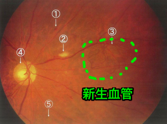 増殖糖尿病網膜症