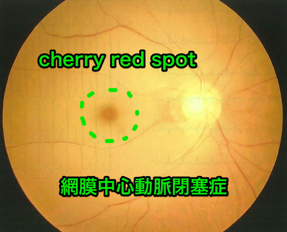 医師国家試験104G54_画像A_網膜中心動脈閉塞症の眼底写真_改変（cherry red spot）