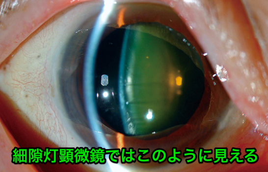 細隙灯顕微鏡での見え方