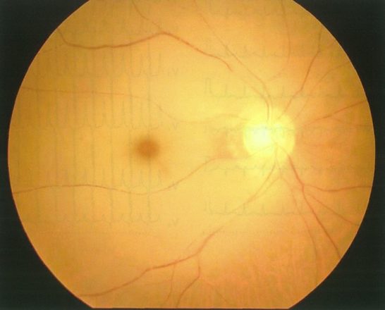 医師国家試験104G54_画像A_網膜中心動脈閉塞症の眼底写真