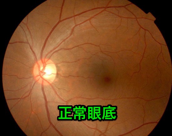 【眼科10】網膜色素変性 〜網膜電位、視野検査〜【108E29、104I14】