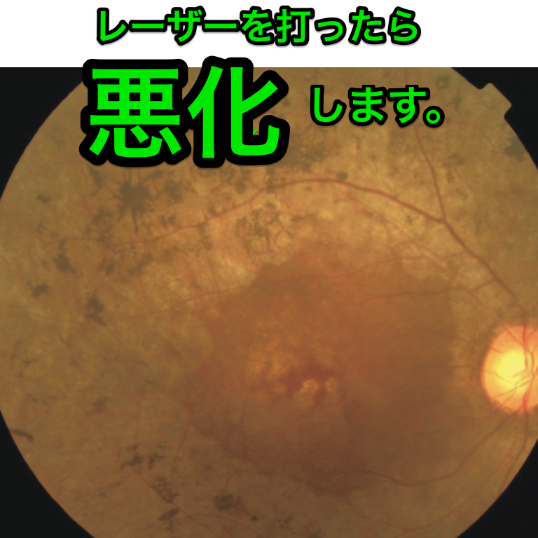 医師国家試験108E29_画像A_網膜色素変性の眼底写真_改変