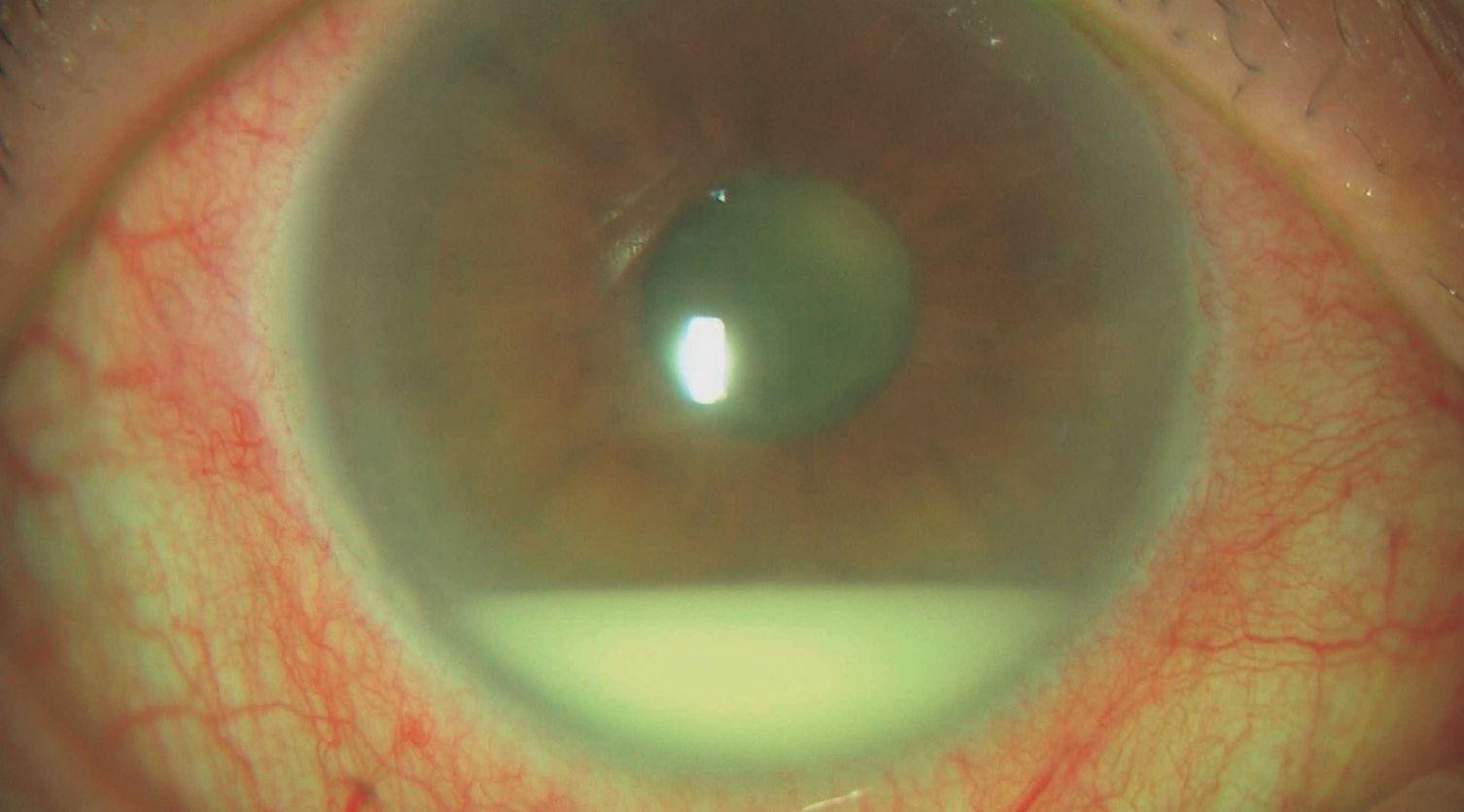 医師国家試験111I77_画像_前房蓄膿（ベーチェット病、Behçet病）の前眼部写真