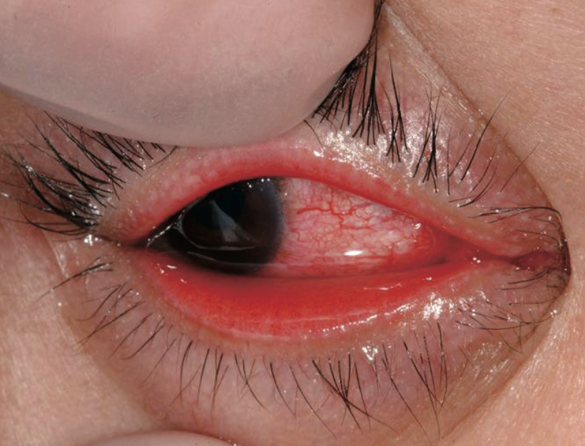医師国家試験106I56_画像B_流行性角結膜炎の顔面の写真