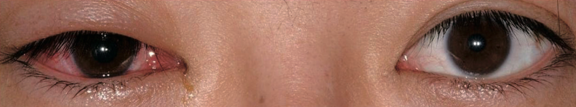 医師国家試験106I56_画像A_流行性角結膜炎の顔面の写真