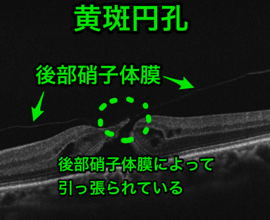 黄斑円孔