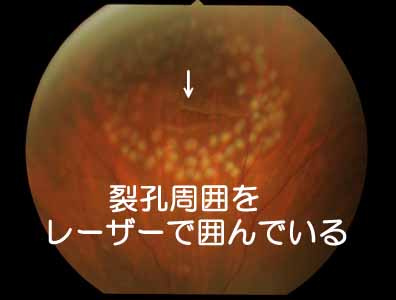 網膜裂孔にレーザー