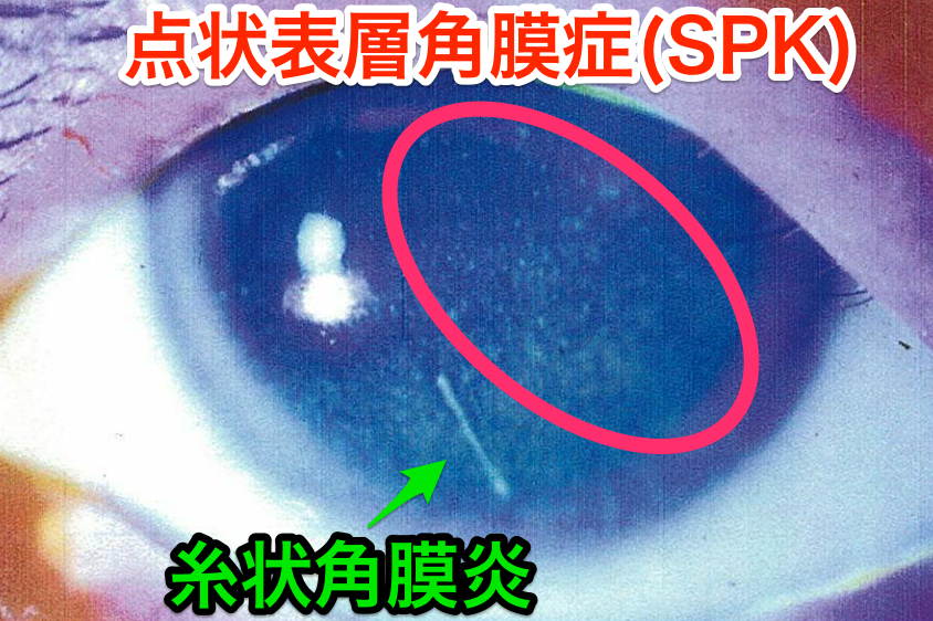 医師国家試験98D8_画像_点状表層角膜症（SPK）_改変