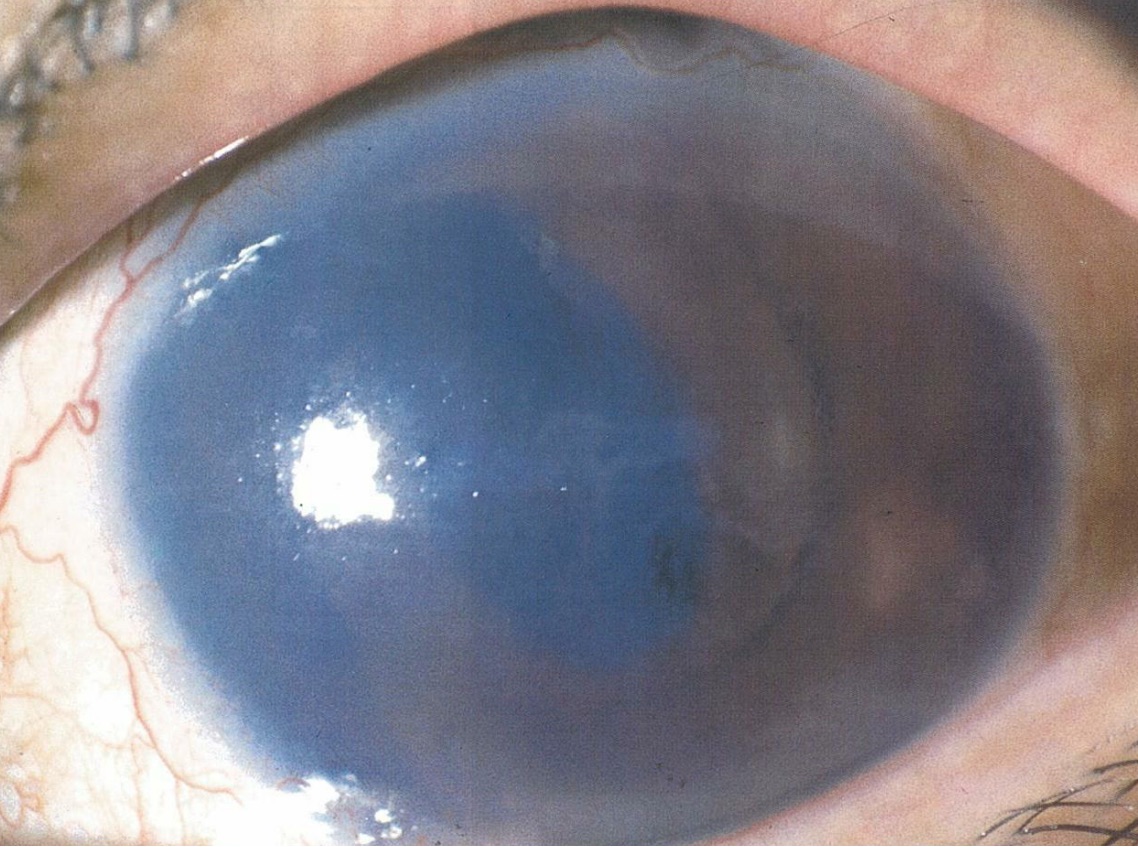 医師国家試験99G9_画像_水疱性角膜症の前眼部写真