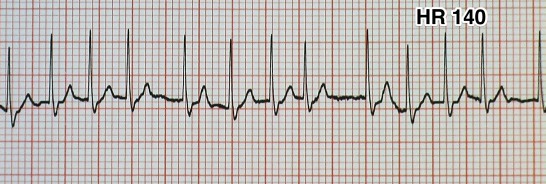 心房細動の心電図